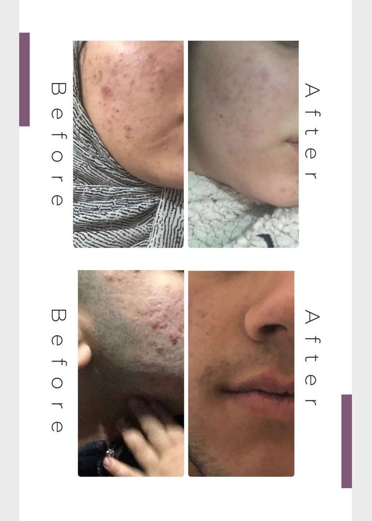 Acne treatment result