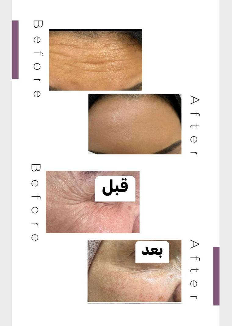 Botox result