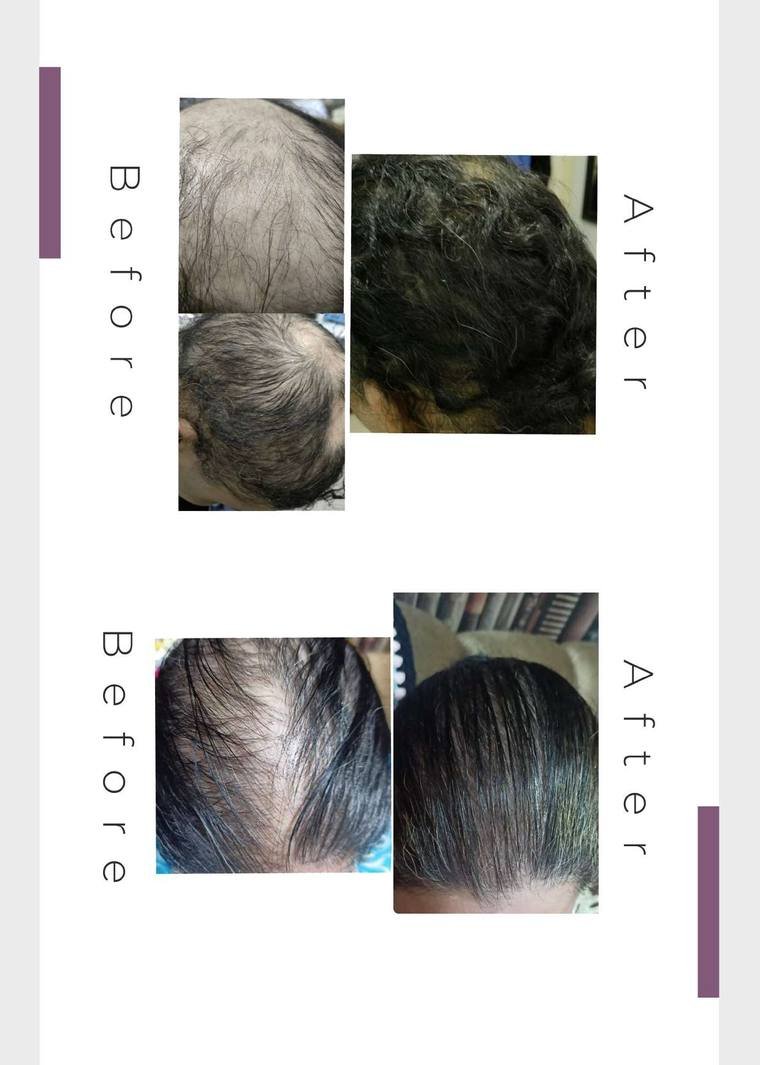 Hair regrowth result