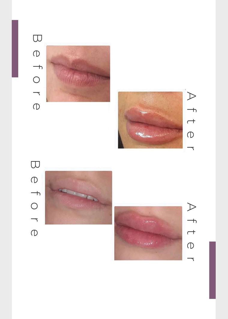 Lip filler result